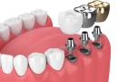 Импланты зубов, как выбрать лучшие