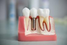  Имплантация, или вживление зубов